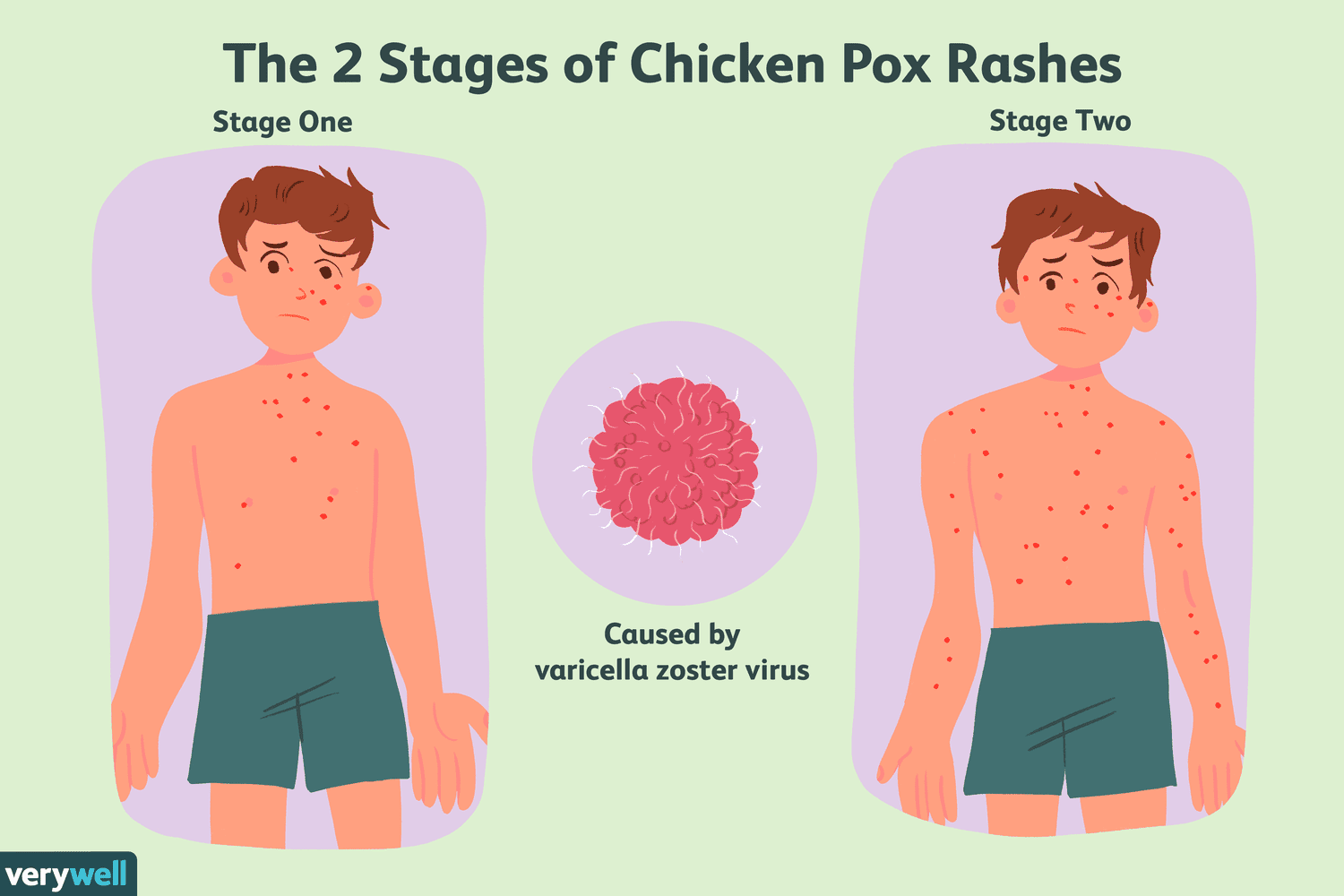 Chickenpox