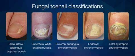 Toenail Fungus