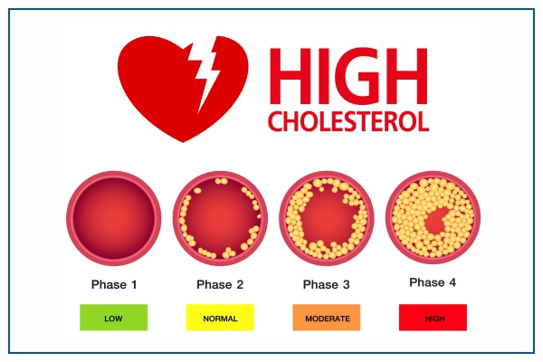 high cholesterol