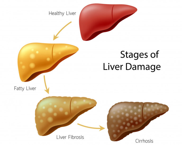 fatty liver